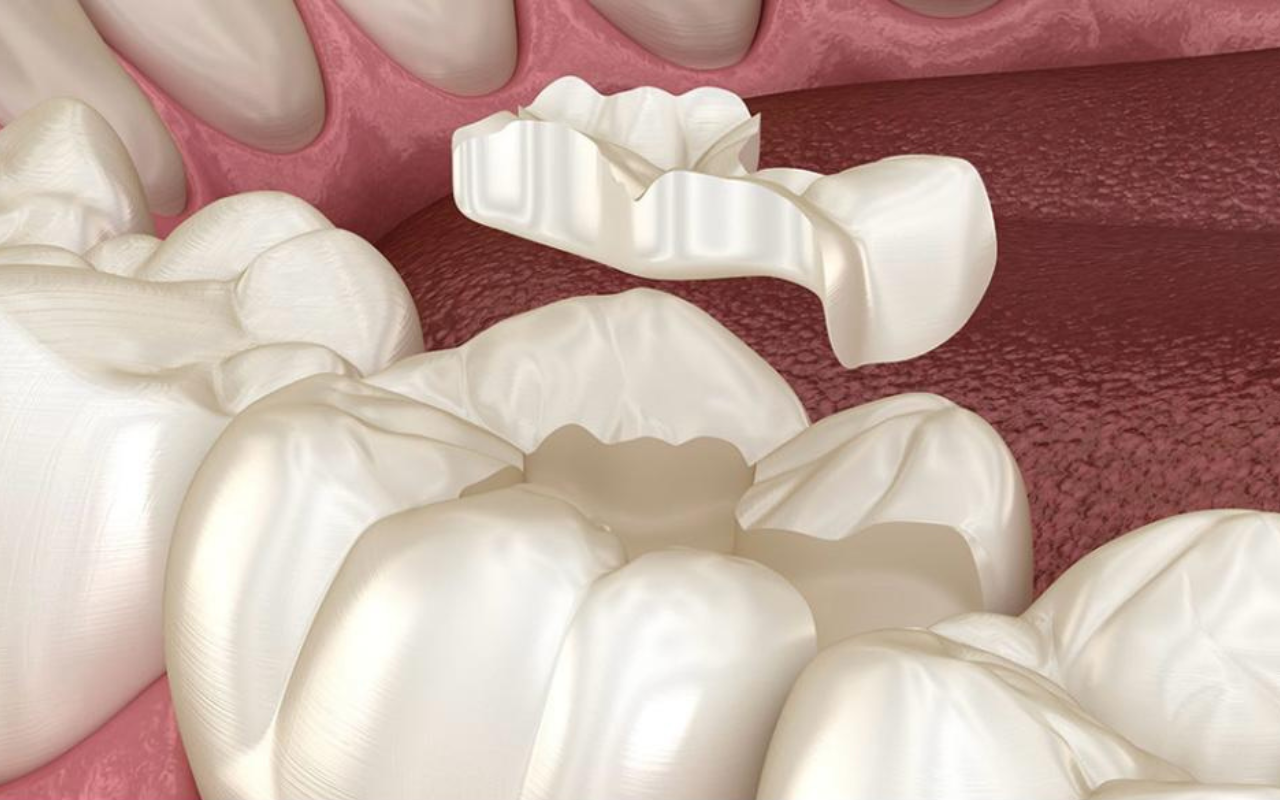 Restauração indireta confeccionada em laboratório pela Dra. Fabiola Roggia